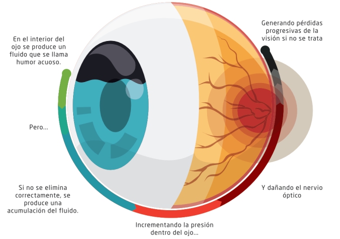 //retinacuernavaca.com.mx/wp-content/uploads/2021/01/Glaucoma-animado.jpg