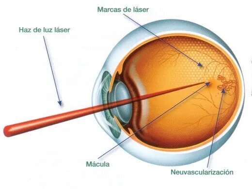 //retinacuernavaca.com.mx/wp-content/uploads/2021/01/Tratamientos-con-Laser-520x390-640w.jpg