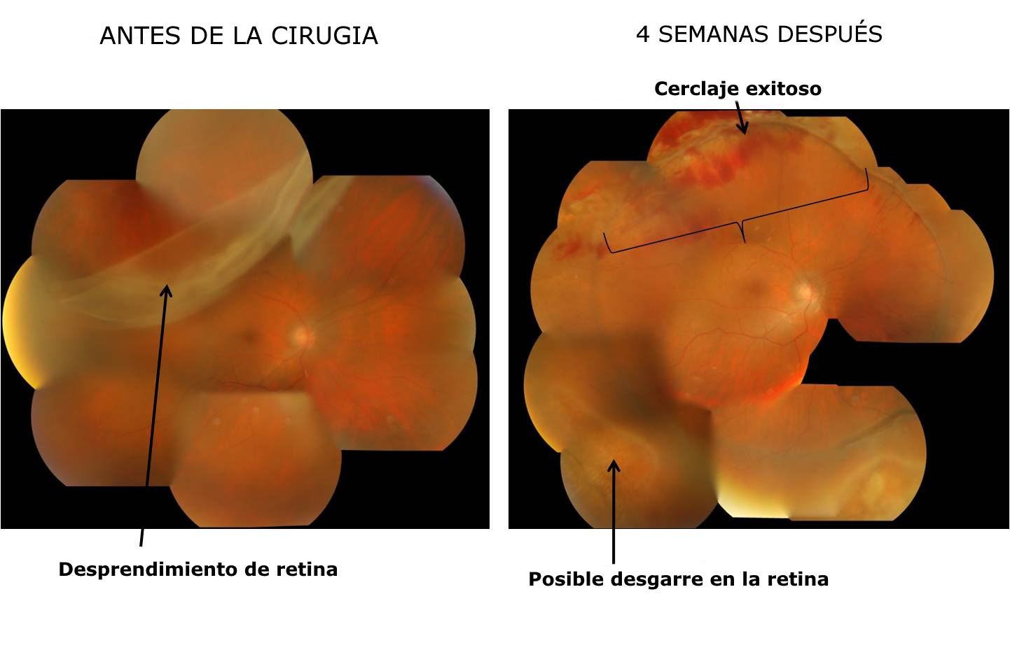 //retinacuernavaca.com.mx/wp-content/uploads/2021/01/antes-y-despues-cirugia.png