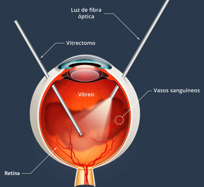 //retinacuernavaca.com.mx/wp-content/uploads/2021/02/imagen_2021-02-02_114028.png