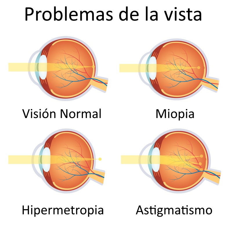 Precio cirugia ocular miopia hot sale