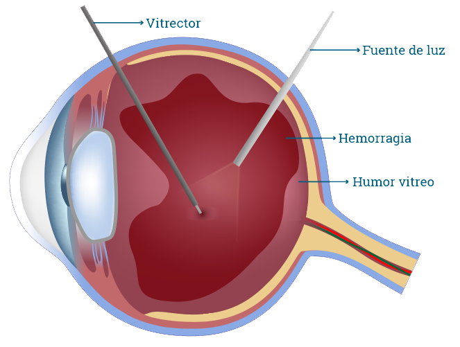 //retinacuernavaca.com.mx/wp-content/uploads/2021/02/vitrectomia.png