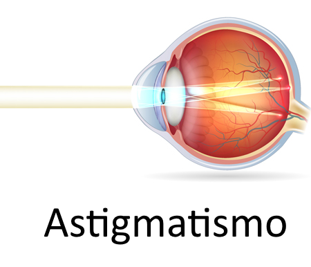 //retinacuernavaca.com.mx/wp-content/uploads/2021/03/ojo-astigmatismo.png